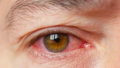 التهاب ملتحمه یا قرمزی چشم چیست ؟